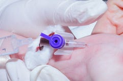 Cateterización intravenosa del primer recién nacido del bebé en la Unidad de Cuidados Intensivos neonatal imagenes de archivo Cateterización intravenosa del primer recién nacido del bebé en la Unidad de Cuidados Intensivos neonatal imagenes de archivo
