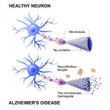 Cellula e neuroni sani con la malattia del ` s di Alzheimer Hypothesi di tau illustrazione di stock Cellula e neuroni sani con la malattia del ` s di Alzheimer Hypothesi di tau illustrazione di stock