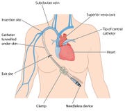 Central venous catheter in subclavian vein