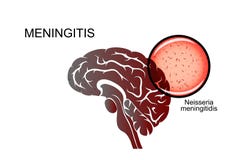 Cerebro, meningitis, el agente causativo de la meningitis ilustración del vector Cerebro, meningitis, el agente causativo de la meningitis ilustración del vector