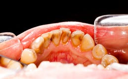 Chapa nos dentes doentes foto de stock Chapa nos dentes doentes foto de stock