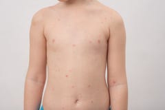Chickenpox, tak?e zna? jako varicella, jest wysoce zara?liwym chorob? powodowa? pocz?tkow? infekcj? z varicella zoster wirusem fotografia royalty free Chickenpox, tak?e zna? jako varicella, jest wysoce zara?liwym chorob? powodowa? pocz?tkow? infekcj? z varicella zoster wirusem fotografia royalty free