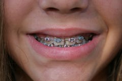 Child With Braces Royalty Free Stock Photos