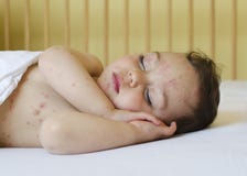 Child With Chicken Pox Stock Images