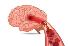 Cholesterol in veins made slow blood flow into brain. vector illustration Cholesterol in veins made slow blood flow into brain. vector illustration