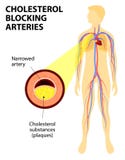 Cholesterolu blokingu arteria ilustracji Cholesterolu blokingu arteria ilustracji