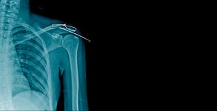 Clavícula de la fractura de la radiografía con la fijación de Op. Sys. de los posts fotos de archivo libres de regalías Clavícula de la fractura de la radiografía con la fijación de Op. Sys. de los posts fotos de archivo libres de regalías