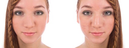 Close-up of teenager face with and without acne royalty free stock image Close-up of teenager face with and without acne royalty free stock image