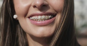 Close up young girl mouth with braces on teeth. stock video Close up young girl mouth with braces on teeth. stock video