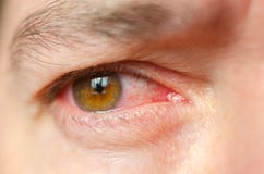 Closeup irritated infected red bloodshot eyes, conjunctivitis stock photo Closeup irritated infected red bloodshot eyes, conjunctivitis stock photo