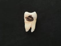 Closeup single bad tooth with caries big hole on black background. Unhealthy teeth Royalty Free Stock Photos Closeup single bad tooth with caries big hole on black background. Unhealthy teeth Royalty Free Stock Photos
