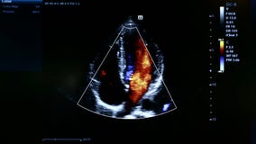 Colourful footage of homan heart ultrasound monitor