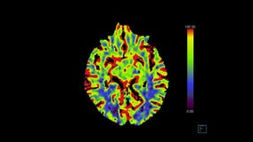 Computed Tomography of the  human brain perfusion study