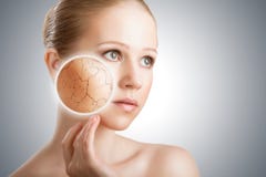 Concept Of Cosmetic Skin Care. Face Of Young Woman With Dry Ski Concept Of Cosmetic Skin Care. Face Of Young Woman With Dry Ski