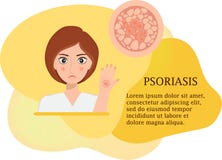 Concept of psoriasis, poster royalty free illustration Concept of psoriasis, poster royalty free illustration