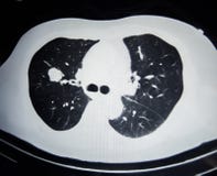 Confuso con rumore di un film di ricerca di Ct del cancro polmonare in bianco e nero chiuda su fotografia stock libera da diritti Confuso con rumore di un film di ricerca di Ct del cancro polmonare in bianco e nero chiuda su fotografia stock libera da diritti