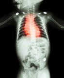Congenital Heart Disease , Rheumatic Heart Disease ( X-ray whole body of child and red color on heart area ) stock images Congenital Heart Disease , Rheumatic Heart Disease ( X-ray whole body of child and red color on heart area ) stock images