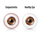 Conjunctivitis. Red Eye. Healthy Eye And Eyeball with Conjunctivitis. Vector Illustration stock illustration Conjunctivitis. Red Eye. Healthy Eye And Eyeball with Conjunctivitis. Vector Illustration stock illustration