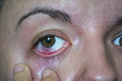 Conjuntivitis u ojo del rosa imágenes de archivo libres de regalías Conjuntivitis u ojo del rosa imágenes de archivo libres de regalías