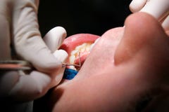 Contrôle dentaire vers le haut Le contrôle dentaire avec les outils dentaires sondent, miroir et tube d'aspiration dans la bouche photos stock Contrôle dentaire vers le haut Le contrôle dentaire avec les outils dentaires sondent, miroir et tube d'aspiration dans la bouche photos stock