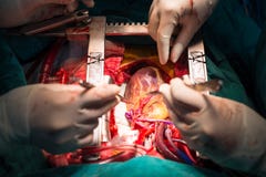 Coronary artery bypass grafting open left internal mammary