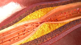 Coronary artery plaque