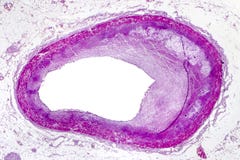Coronary atherosclerosis, light micrograph