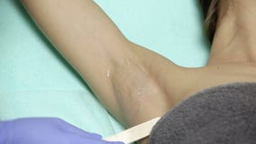 Cosmetologist past gel op oksels van patiënt toe vóór epilationprocedure stock video Cosmetologist past gel op oksels van patiënt toe vóór epilationprocedure stock video