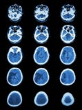 CT scan (computed tomography) of brain show cerebral infarction stock image CT scan (computed tomography) of brain show cerebral infarction stock image