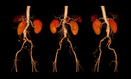 abdominal aortic aneurysm aorta cta femoral run off ct