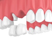 3d rendem da ponte de modilhão dental com as coroas na maxila superior ilustração royalty free 3d rendem da ponte de modilhão dental com as coroas na maxila superior ilustração royalty free