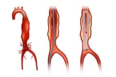 De reparatie van het Endovascularaneurisma royalty-vrije illustratie De reparatie van het Endovascularaneurisma royalty-vrije illustratie
