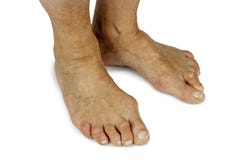 Deformidade do Bunion foto de stock royalty free Deformidade do Bunion foto de stock royalty free