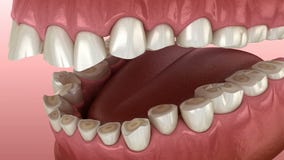 Dental attrition Bruxism resulting in loss of tooth tissue.  Medically accurate tooth 3D animation