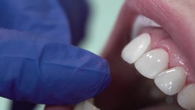 Dentist puts dental veneers patient
