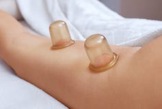 Der Masseur macht Massage mit Gläsern Cellulite auf dem Hinterteil und den Schenkeln des Patienten stockbild Der Masseur macht Massage mit Gläsern Cellulite auf dem Hinterteil und den Schenkeln des Patienten stockbild