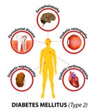 Diabetes mellitus complicaciones a largo plazo ilustración del vector Diabetes mellitus complicaciones a largo plazo ilustración del vector