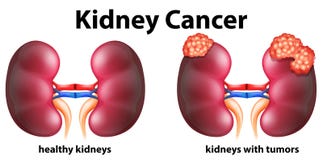 Diagram showing kidney cancer in human Stock Image Diagram showing kidney cancer in human Stock Image