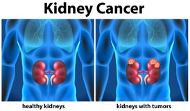 Diagram showing kidney cancer in human Royalty Free Stock Image Diagram showing kidney cancer in human Royalty Free Stock Image
