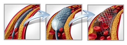 Diagramme coronaire de Stent illustration de vecteur Diagramme coronaire de Stent illustration de vecteur