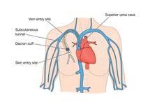 Dibujo de la inserción del catéter en corazón libre illustration Dibujo de la inserción del catéter en corazón libre illustration