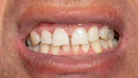 Dientes humanos con la placa y el t?rtaro que fuman Macro del primer en cl?nica dental Huevo en tocador foto de archivo libre de regalías Dientes humanos con la placa y el t?rtaro que fuman Macro del primer en cl?nica dental Huevo en tocador foto de archivo libre de regalías