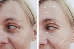 Diferença paciente antes e depois dos procedimentos, seta do enchimento adulto fêmea da dermatologia da remoção dos enrugamentos imagem de stock royalty free Diferença paciente antes e depois dos procedimentos, seta do enchimento adulto fêmea da dermatologia da remoção dos enrugamentos imagem de stock royalty free