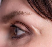 Djupt ärr och ärr på framsidan av flickan nära ögat, närbild, hudproblem, cosmetology arkivfoto Djupt ärr och ärr på framsidan av flickan nära ögat, närbild, hudproblem, cosmetology arkivfoto