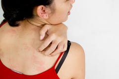 Dos moral de jeune femme avec la peau irritante photos libres de droits Dos moral de jeune femme avec la peau irritante photos libres de droits