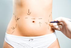Drawing marks for abdominal plastic surgery