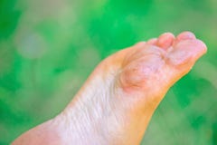 Droog ontwaterde huid op de hielen van vrouwelijke voeten met calluses stock afbeelding Droog ontwaterde huid op de hielen van vrouwelijke voeten met calluses stock afbeelding