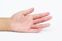 The Dry hands, peel, Contact dermatitis, fungal infections, Skin inf stock photo The Dry hands, peel, Contact dermatitis, fungal infections, Skin inf stock photo