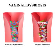 Dysbiosis vaginal Dysbacteriosis du vagin Candidiase de Vaginitis Lactobacille, bifidobacteria Flore pathogène de bactéries Images stock Dysbiosis vaginal Dysbacteriosis du vagin Candidiase de Vaginitis Lactobacille, bifidobacteria Flore pathogène de bactéries Images stock