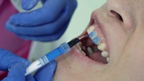 El dentista pone la base para colocar las chapas dentales El dentista pone la base para colocar las chapas dentales